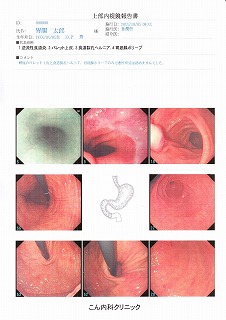 上部内視鏡検査（患者用）