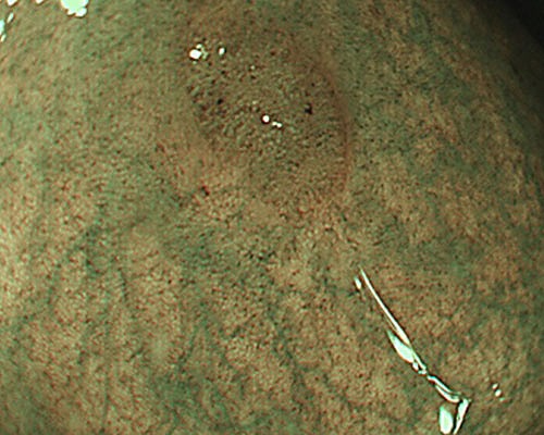 NBIに切り替えることで病変部が確認できます。