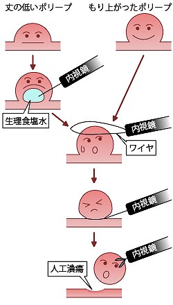 大腸ポリープ切除「日帰り手術」と合併症対策