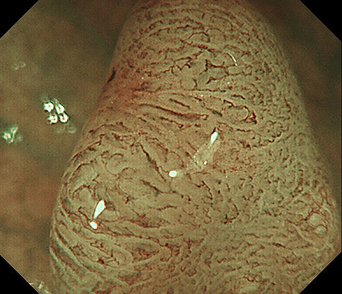 ③通電ポリペクNBI拡大像