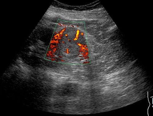 パワードップラー法にて腫瘤（病変部）の中に微細な血流を検出出来、腫瘍内に腫瘍血管が発達して腎細胞癌と質的診断が可能です。