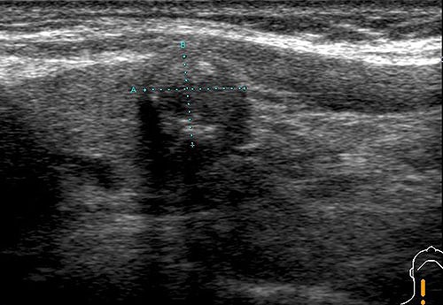 中央のカーソル付近が甲状腺がんです。