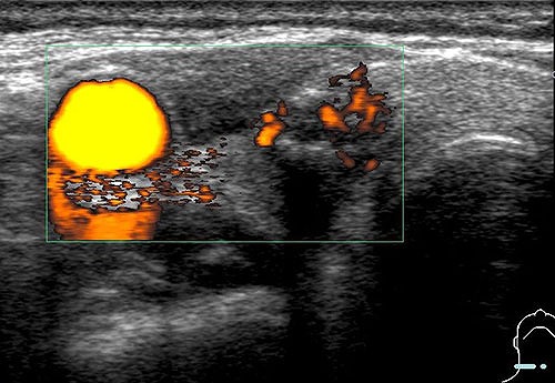 パワードプラーに変えることで腫瘤（病変部）の中に微細な血流を検出することができます。